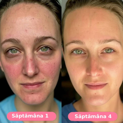 Serum collagen