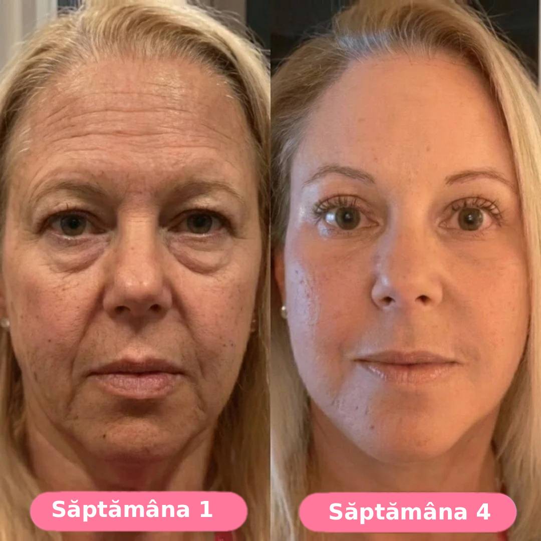 Serum collagen