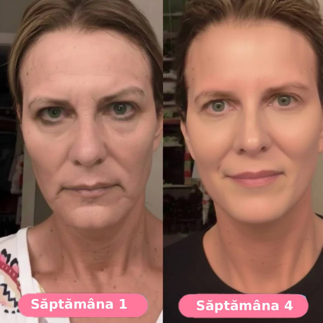 Serum collagen